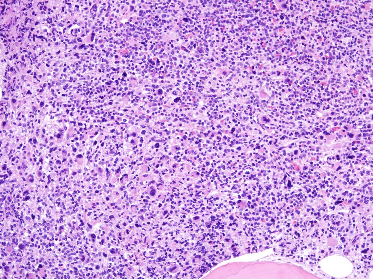 Submitted marrow (1999): Numerous blasts admixed with dysplastic megakaryocytes.